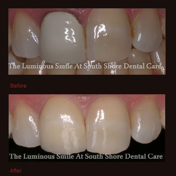 Before and after single dark tooth and veneer repair