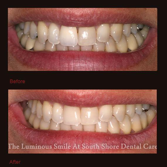 Before and after discolored tooth and veneer repair
