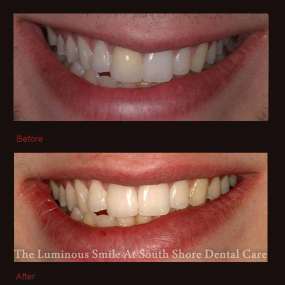 Before and after yellowed tooth and veneer repair