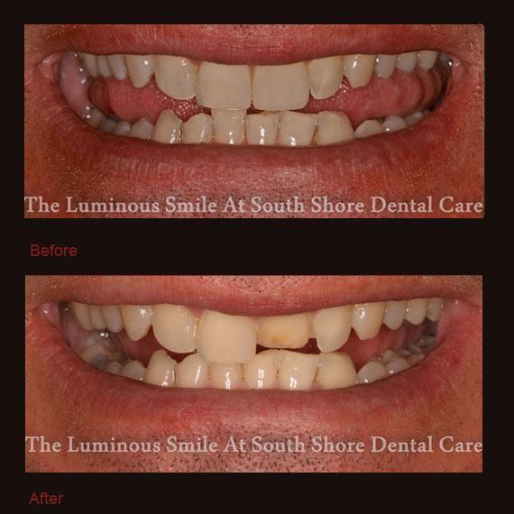 Before and after short front tooth and veneer repair