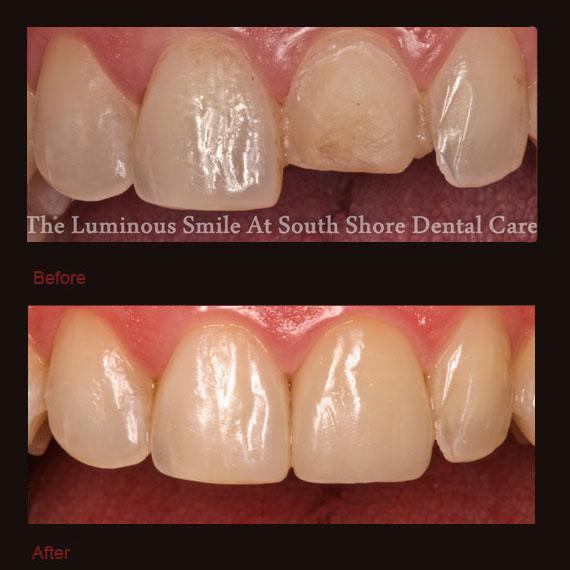 Before and after yellow worn tooth and veneer repair