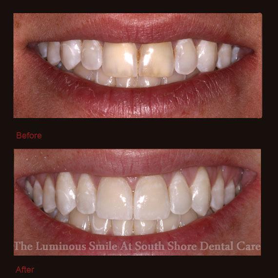 Yellowed front teeth and veneer repair