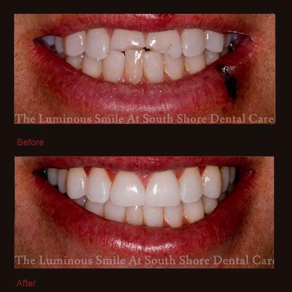 Broken front teeth and veneer repair