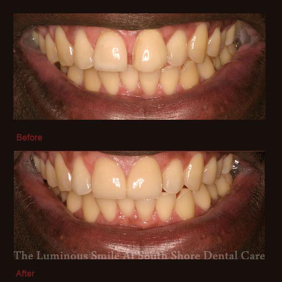 Yellow gapped front teeth and veneer repair