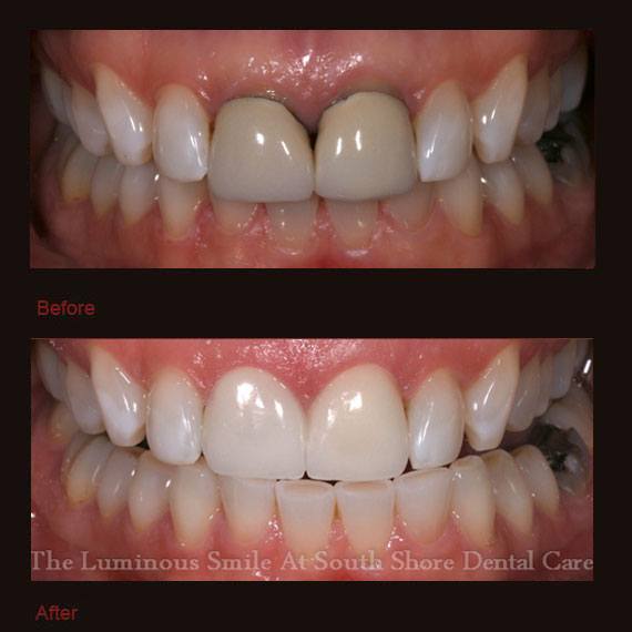 Gray and black discoloration on front teeth and veneer repair