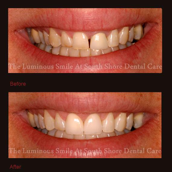 Decayed and gapped front teeth and veneer repair