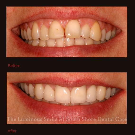 Decayed and discolored four front teeth and veneer repair