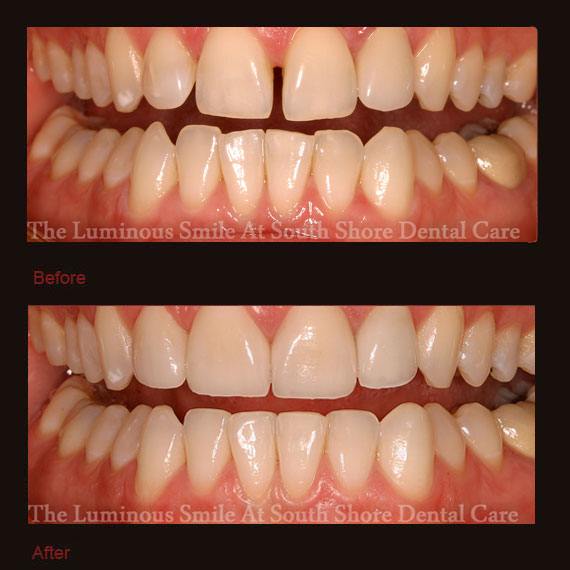 Crooked front teeth and veneer repair