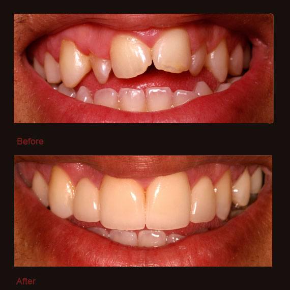 Small and damaged front teeth and veneer repair