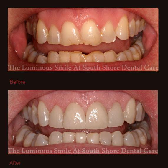 Chipped and decayed front teeth and veneer repair