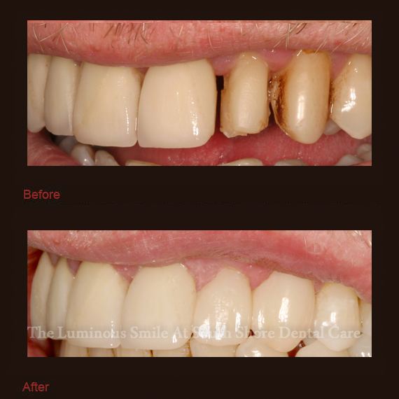 severely decayed teeth repaired with bonding