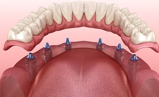 illustration of All-on-6 dental implants in Massapequa Park