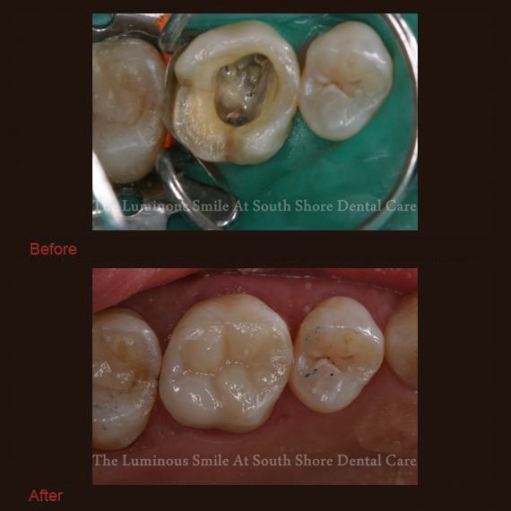 Tooth after amalgam removal and bonding repair