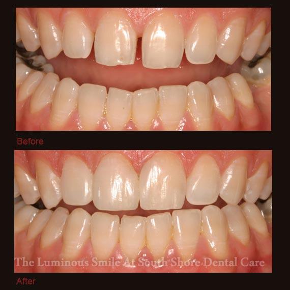 Gapped front teeth repaired with bonding