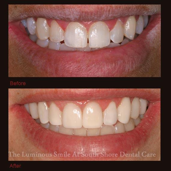 Discolored top teeth repaired with bonding