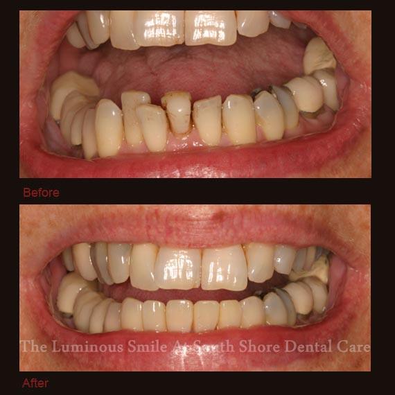 Decayed bottom teeth repaired with bonding