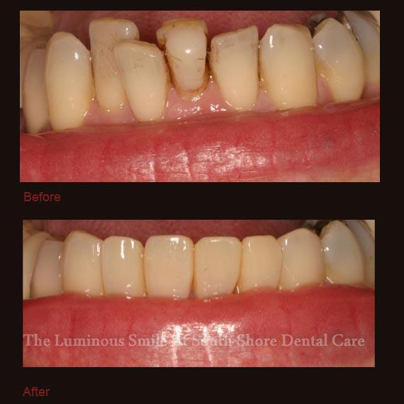Damaged bottom tooth repaired with bonding