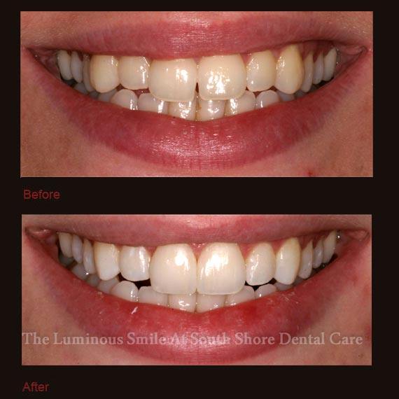 Yellow front teeth repaired with bonding