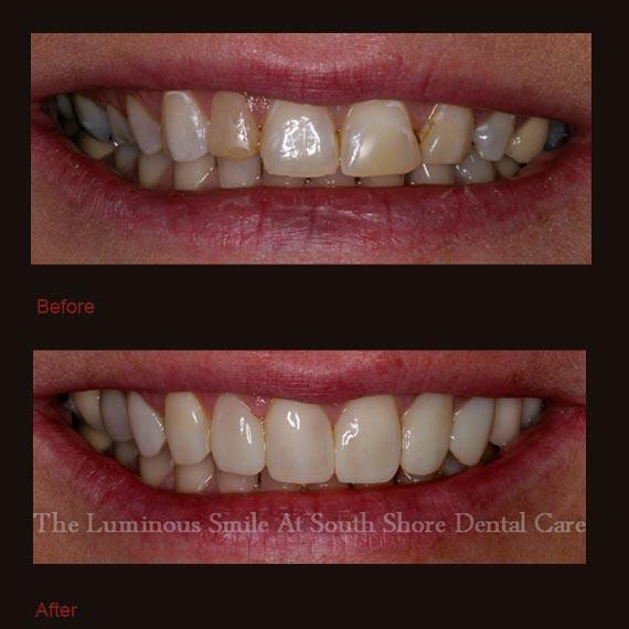 Dark front teeth repaired with bonding