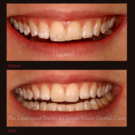 Worn discolored teeth repaired with bonding