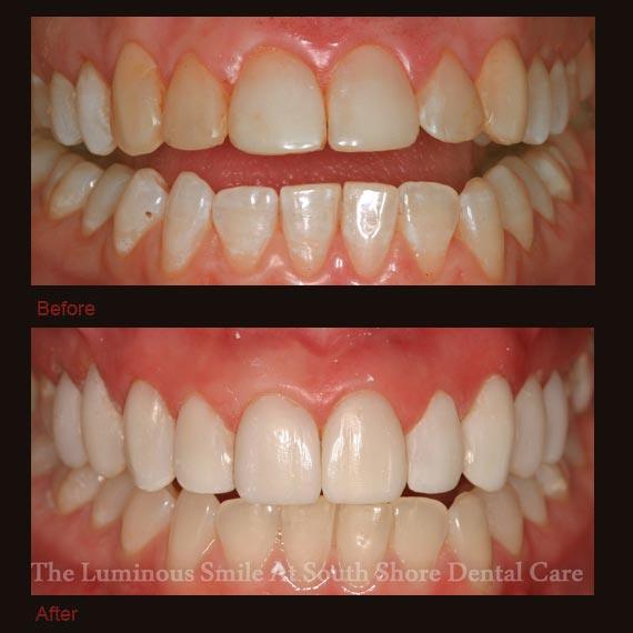 Yellowed decayed top teeth repaired with bonding