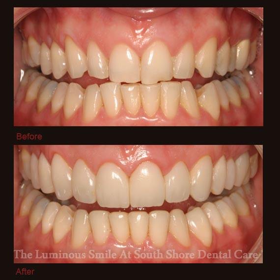 Cracked chipped and worn teeth repaired with bonding