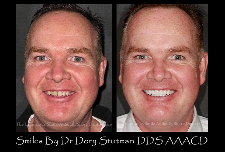 Before and after images of older male patient