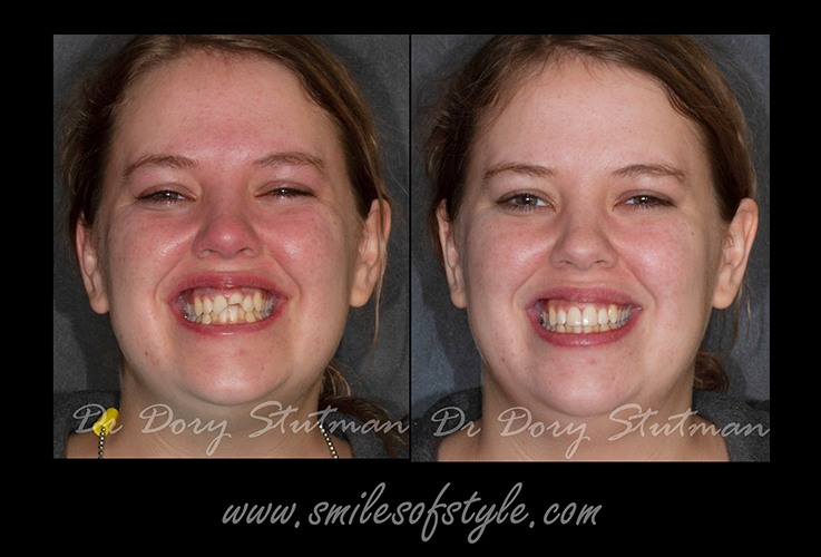 Young woman before and after smile repair
