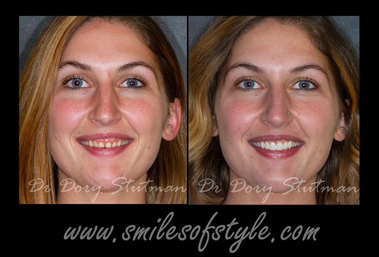 Woman before and after gum recontouring