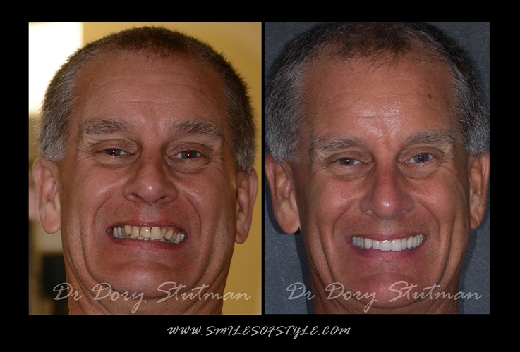 Older man before and after treatment