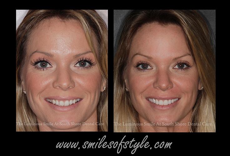 Woman before and after cosmetic dentistry