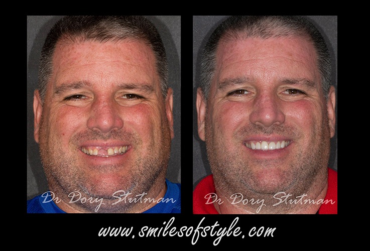 Man before and after tooth replacement