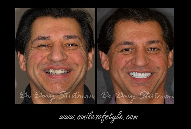 Man with flawless smile before and after treatment