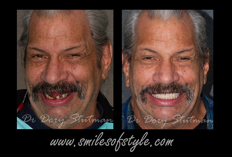 Man before and after smile reconstruction
