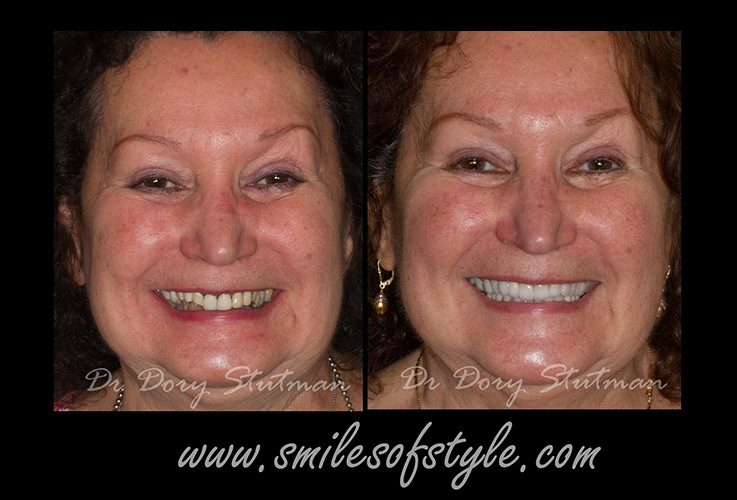 Woman before and after smile repair
