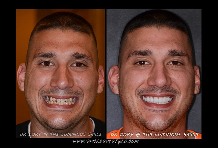 Man before and after smile repair
