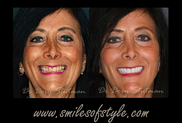 Before and after images of older female patient