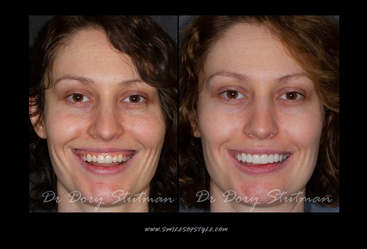 Young woman before and after smile reshaping