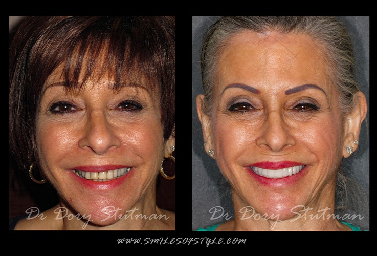 Smiling older woman before and after dentistry