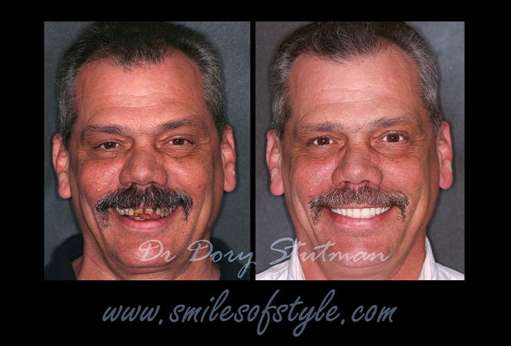 Older man before and after complete smile makeover