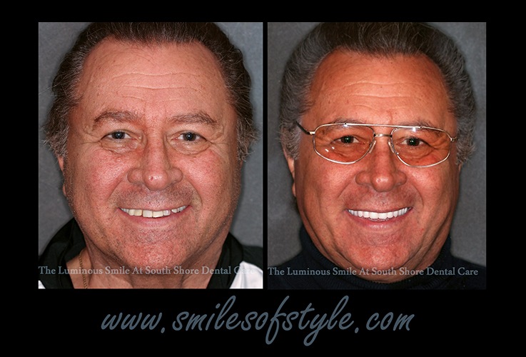 Older man before and after cosmetic dentistr