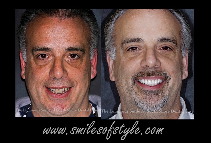 Older male patient beofre and after treatment