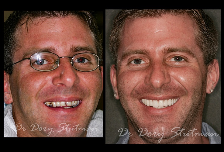 Young man before and after cosmetic dental care