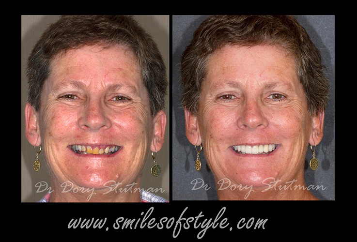 Older woman before and after smile enhancement