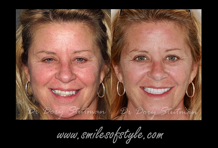 Woman before and after dentistry