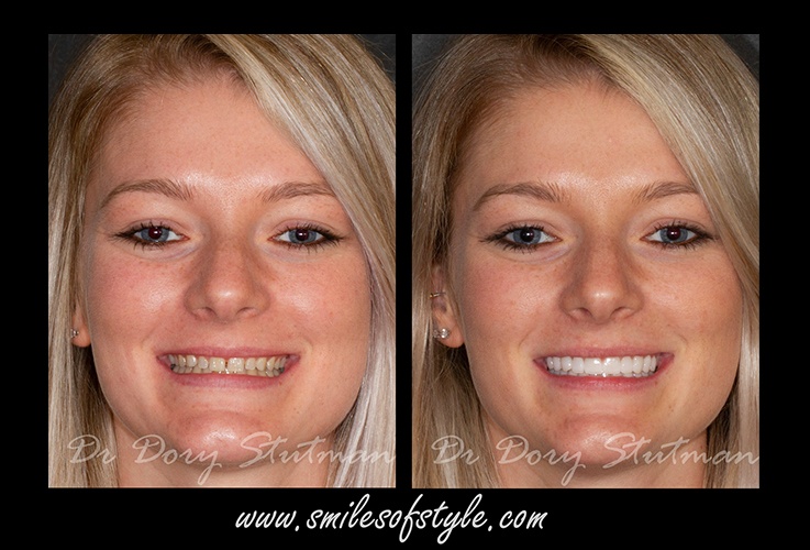 Before and after images of young female patient