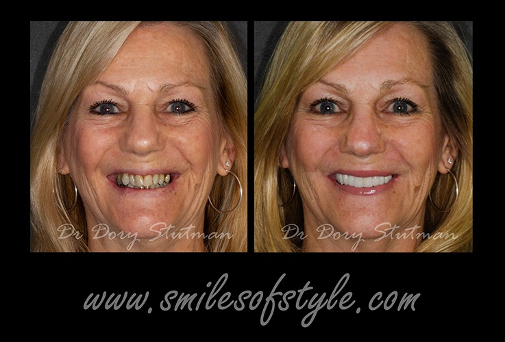 Older woman before and after treatment