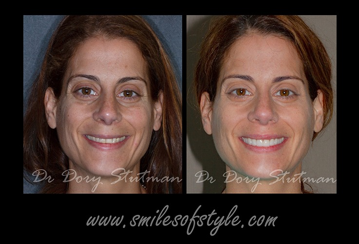 Woman before and after dental care