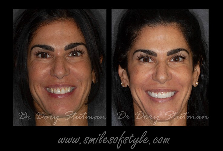 Woman with flawless smile after treatment