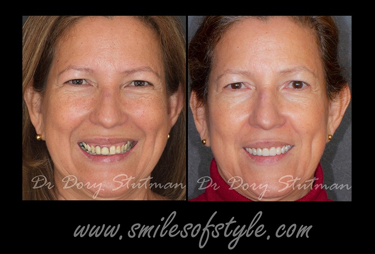 Older woman before and after dental care